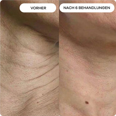 Faltige, erschlaffte Halshaut