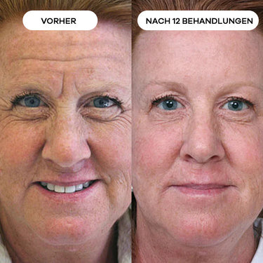 Stirnfalten & Zornesfalten