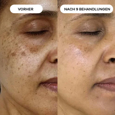 Pigment & Altersflecken