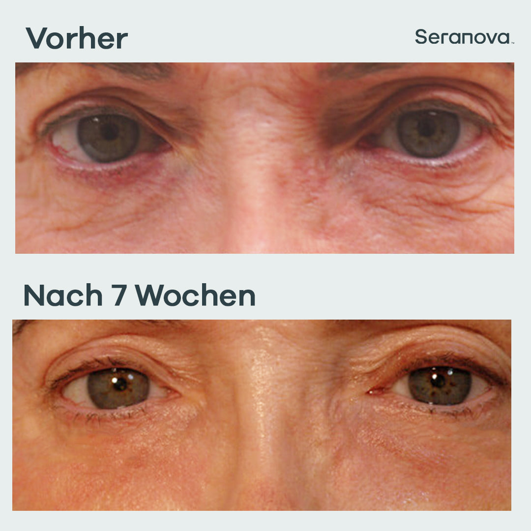 Micro Infusion Patches