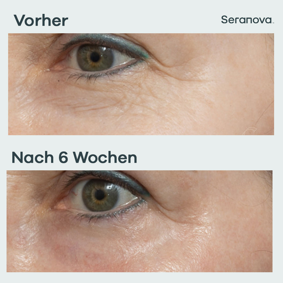 Micro Infusion Patches