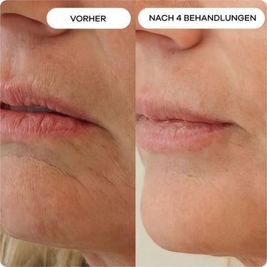 Dünne & faltige Lippen