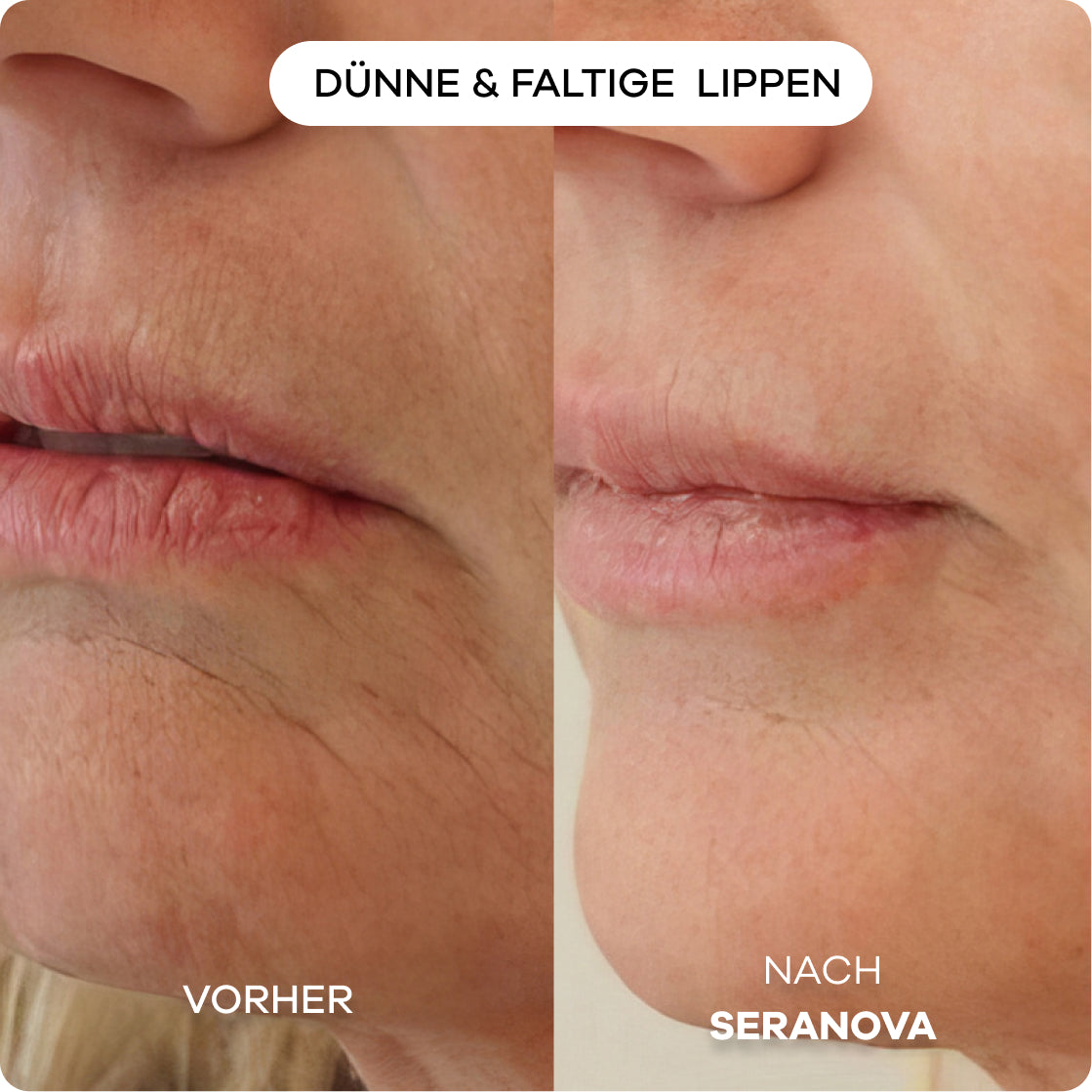 Seranova Micro-Infusion System™ - Seranova DE