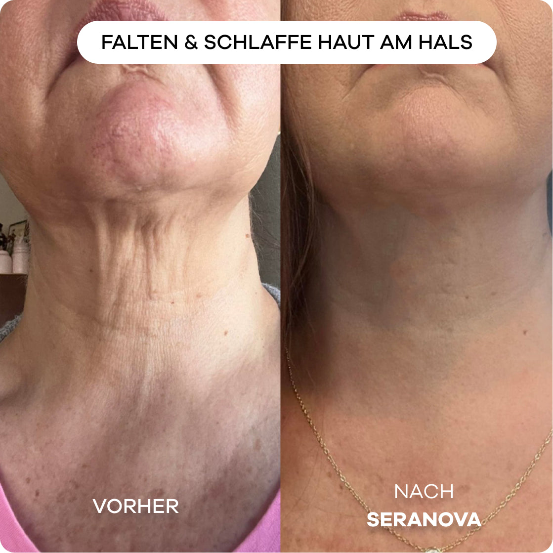 Seranova Micro-Infusion System™ - Seranova DE