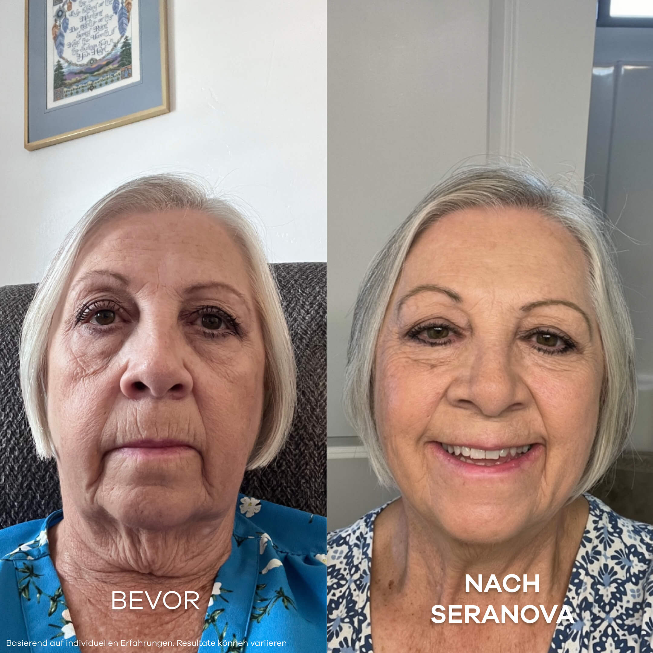 Seranova Micro Infusion System™ - Seranova DACH