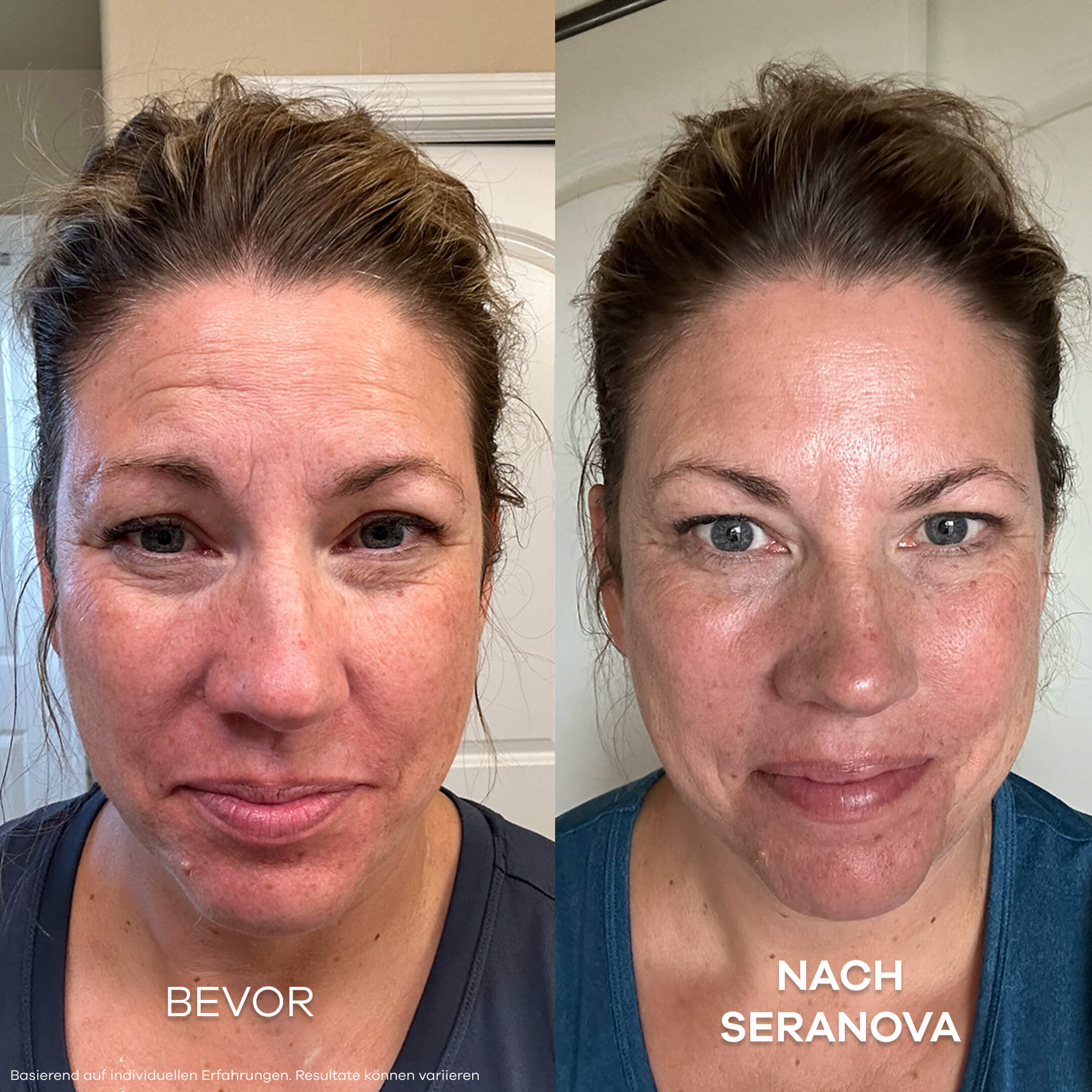 Seranova Micro Infusion System™ - Seranova DACH