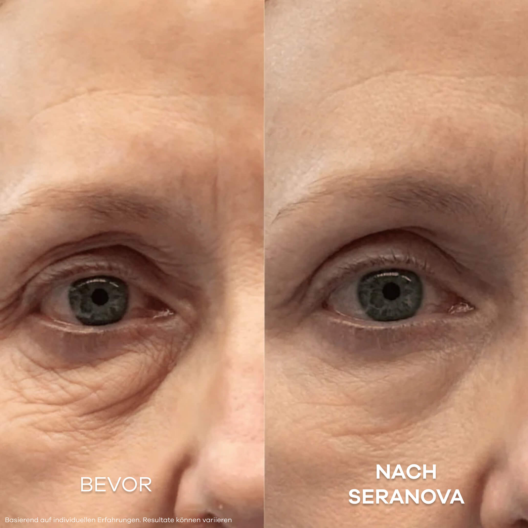 Seranova Micro Infusion System™ - Seranova DACH
