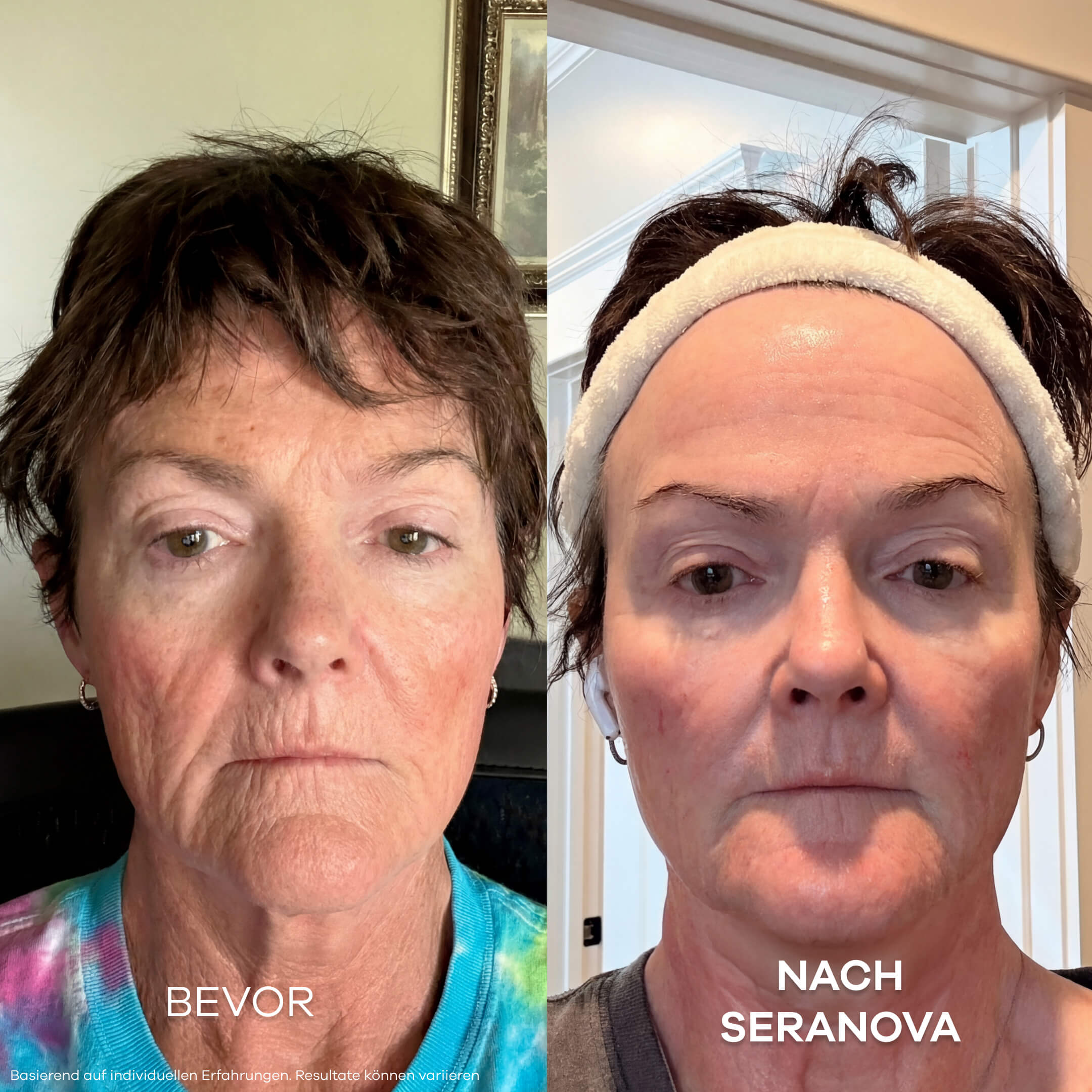 Seranova Micro Infusion System™ - Seranova DACH