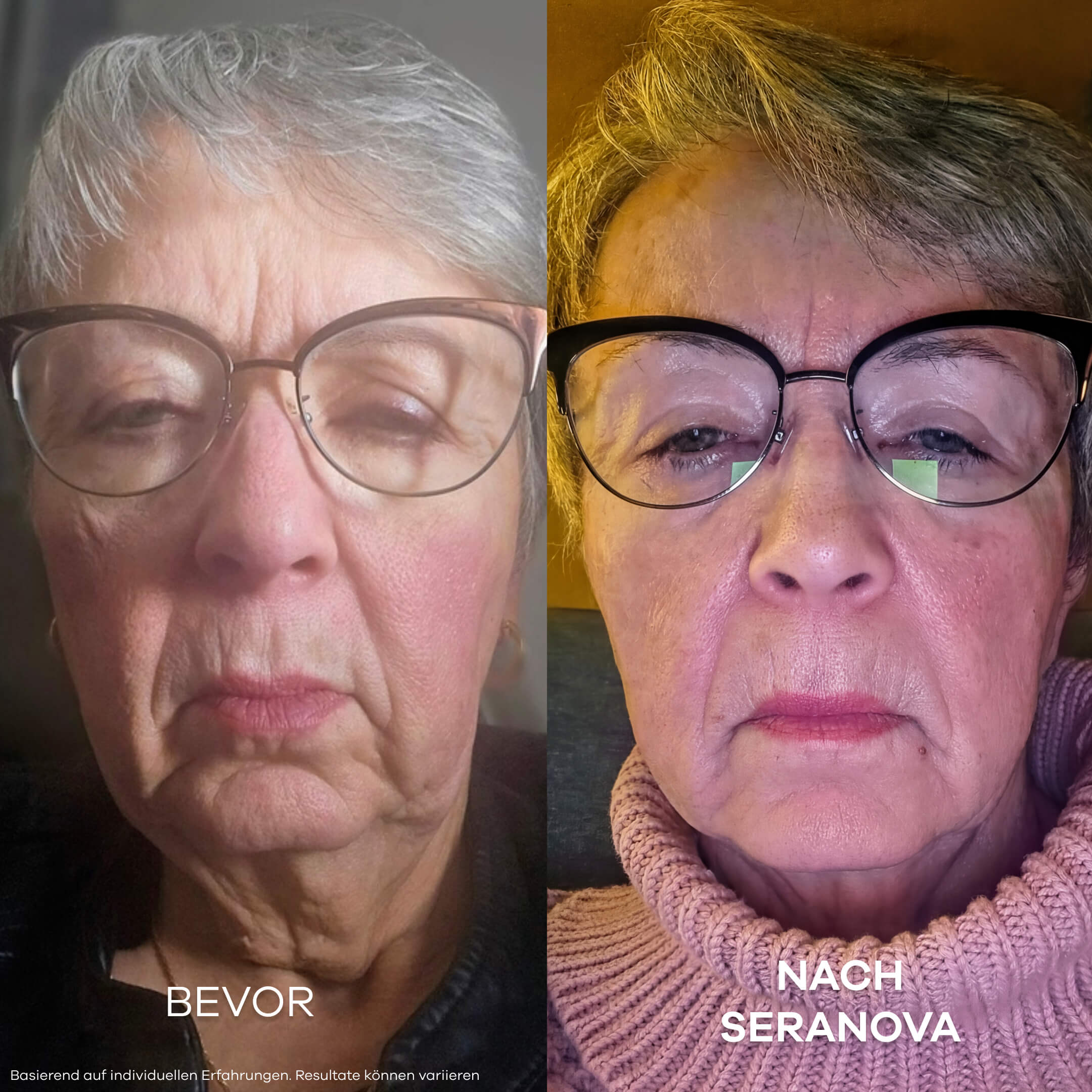 Seranova Micro Infusion System™ - Seranova DACH