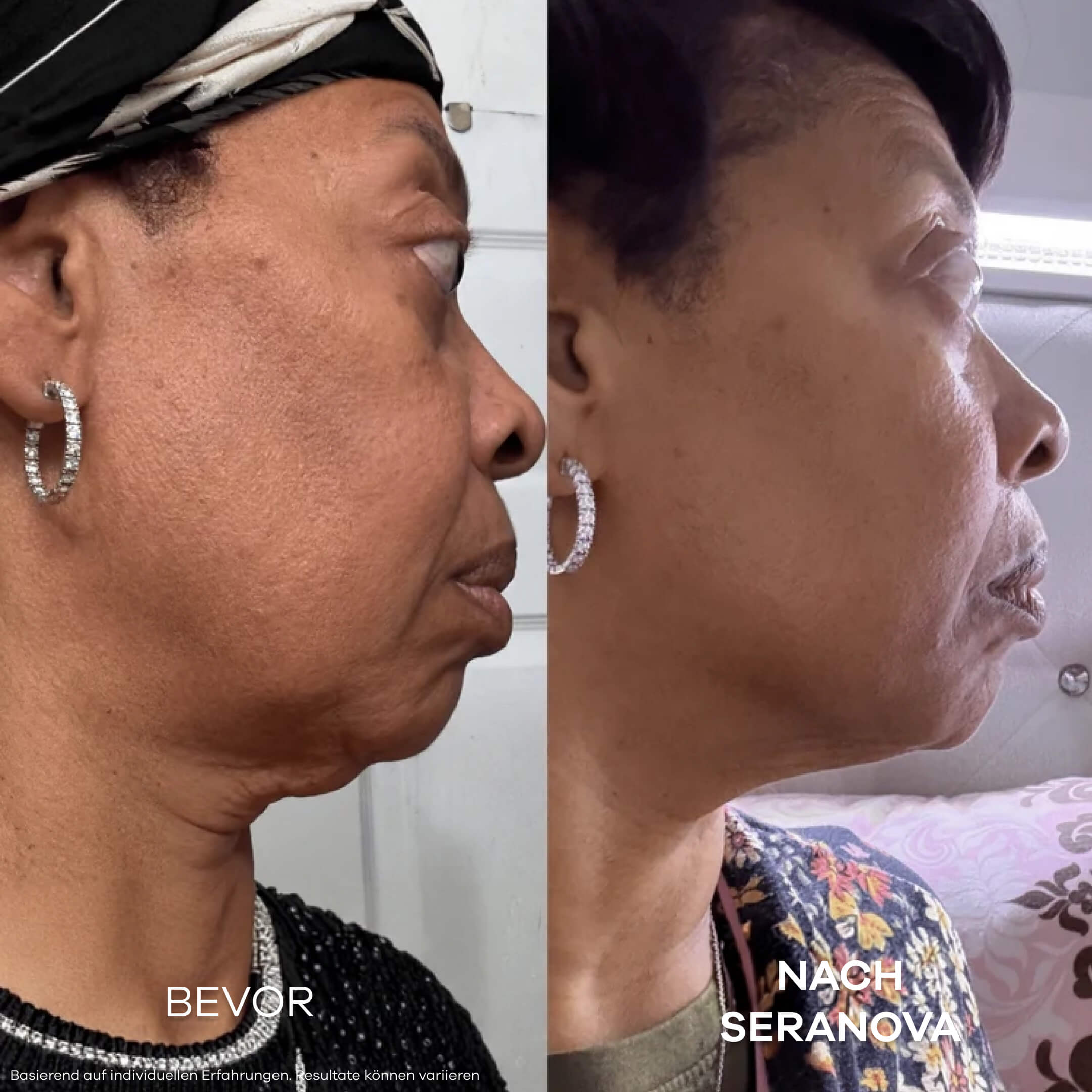 Seranova Micro Infusion System™ - Seranova DACH