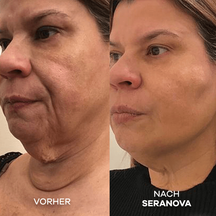 Seranova Micro Infusion System™