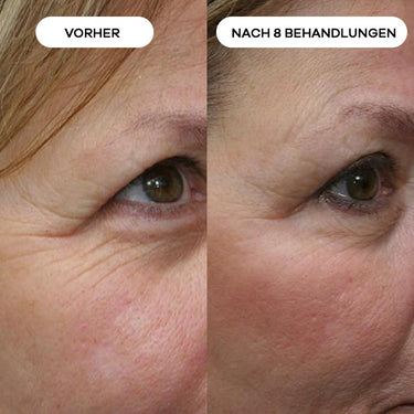 Krähenfüße