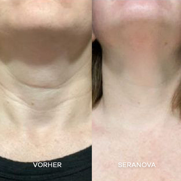 Seranova Micro Infusion System™ | Seranova DACH