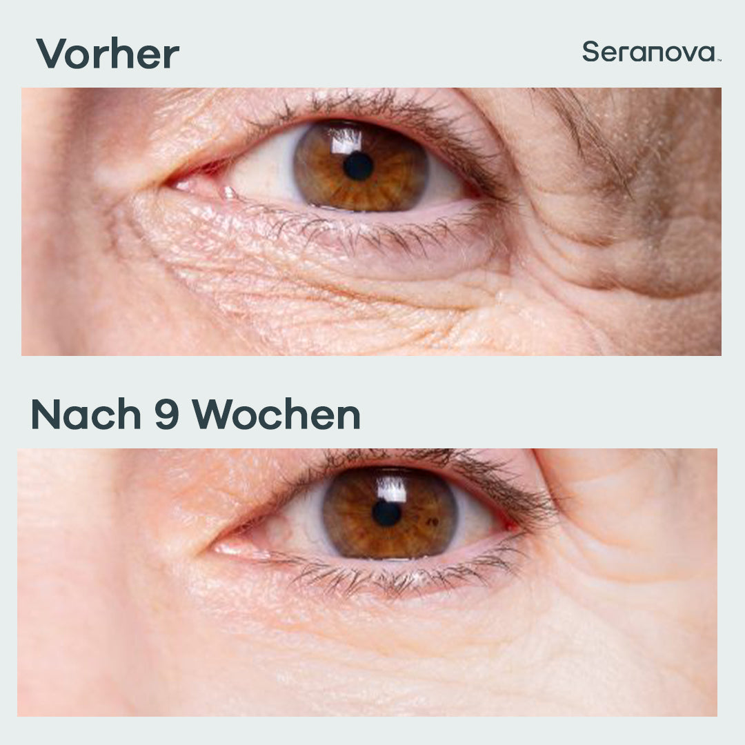 Micro Infusion Patches - 3-Monats-Vorrat